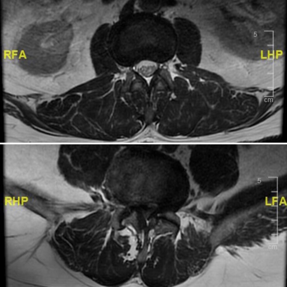 Estenosis De Canal Lumbar Qué Es Síntomas Y Por Qué Elegir El Tratamiento Quirúrgico Dra 7759